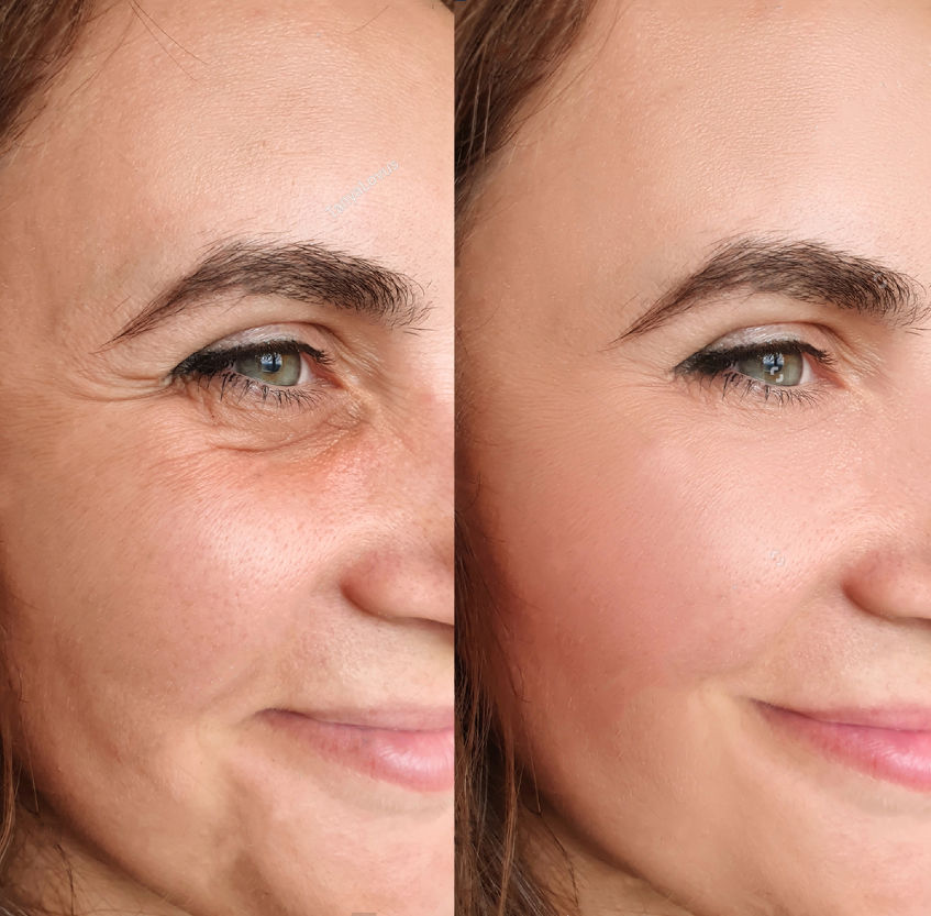 Non Invasive Mesotherapy Eye Contour reduces eye bags, dark circles, wrinkles, fine lines