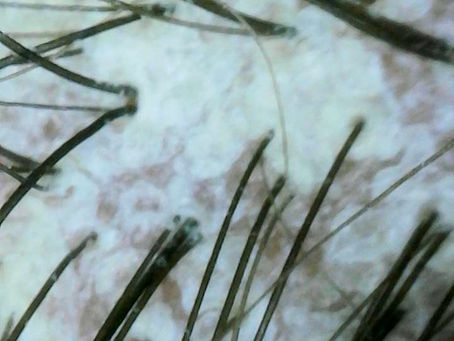 Dry Scalp vs. Dandruff: The Clinical Difference (And How to Treat Each Correctly)