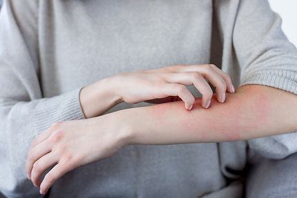 湿疹がでて痒い腕
