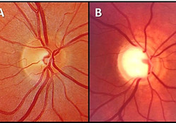 Retinografia comparando em A o nervo óptico normal e em B o nervo óptico glaucomatoso.