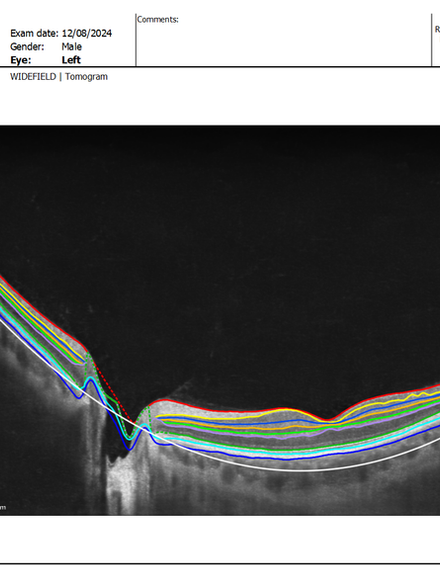 OCT de Mácula para avaliar a Saúde do Fundo de Olho