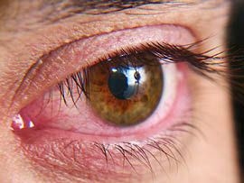 Caso de Olho Seco Moderado com Vermelhidão dos Olhos Moderada.