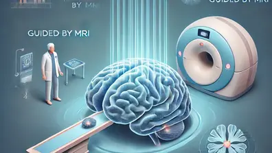 Ultrasonido focalizado en Parkinson: una opción innovadora que está cambiando vidas