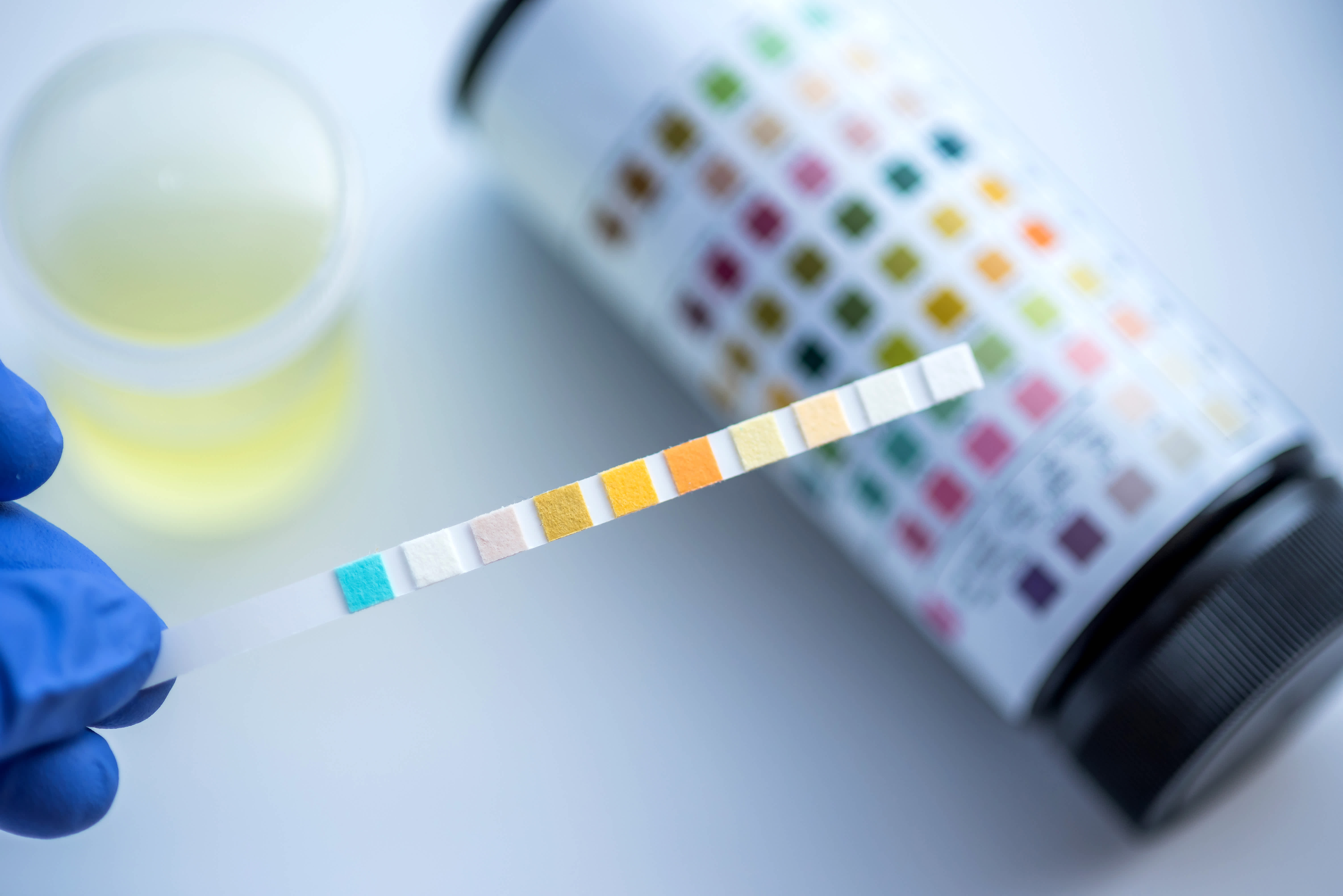 How Accurate Are The Urine Dipstick Tests For Diagnosing UTIs?