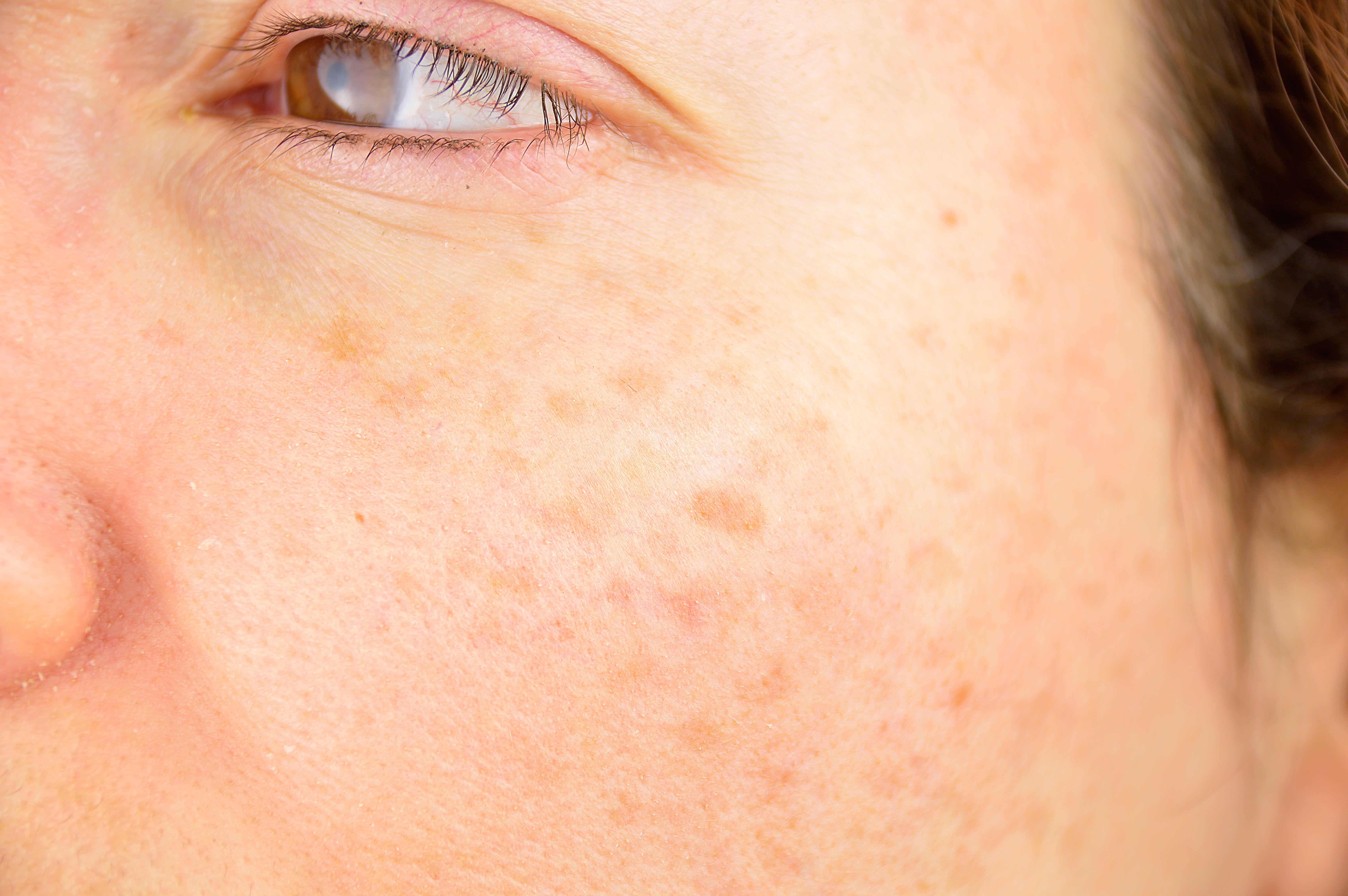 6 Signs of Low Glutathione: How It Affects Your Skin's Health