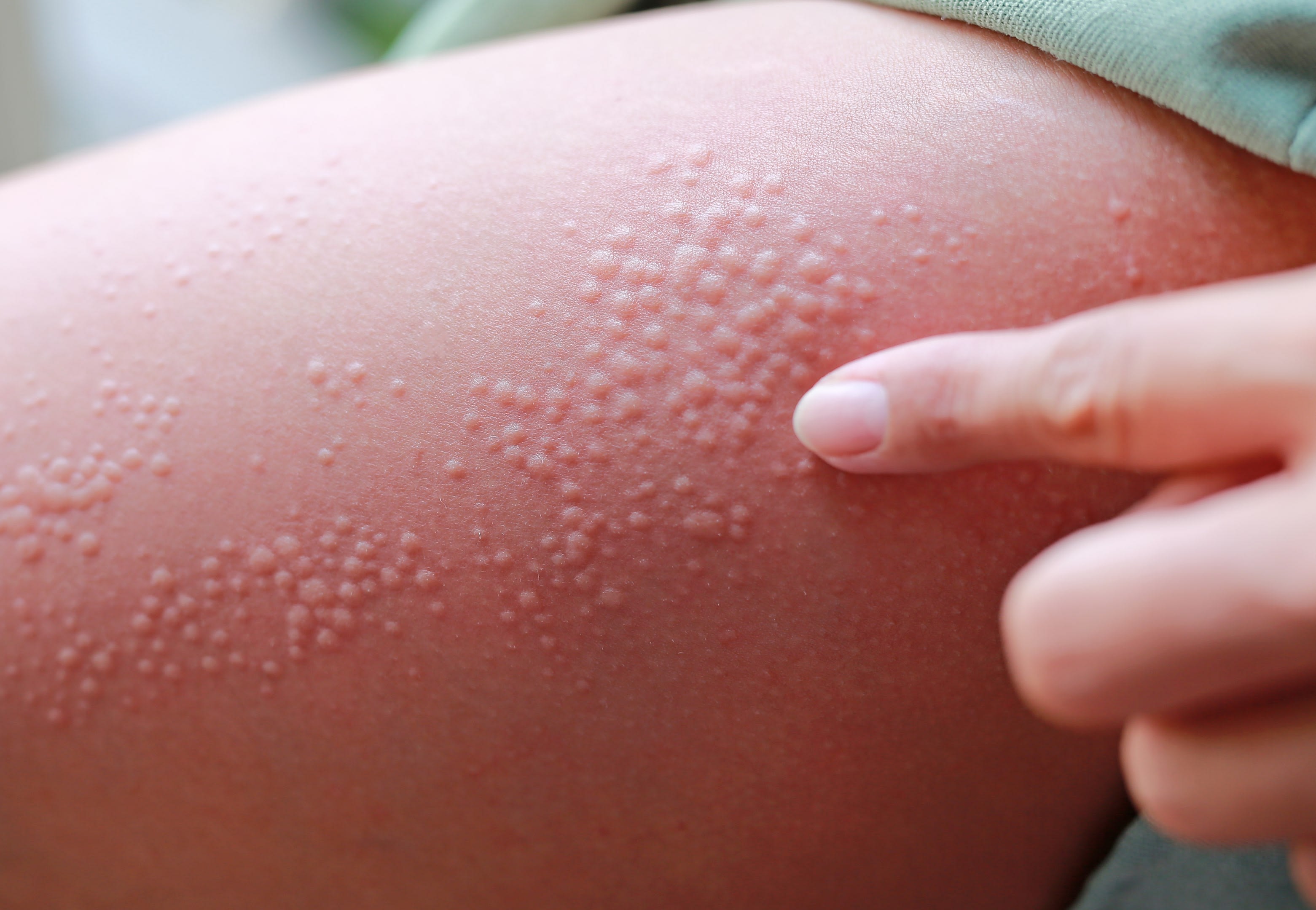 How Does Stress Affect Skin? Causes, Effects, and Solutions