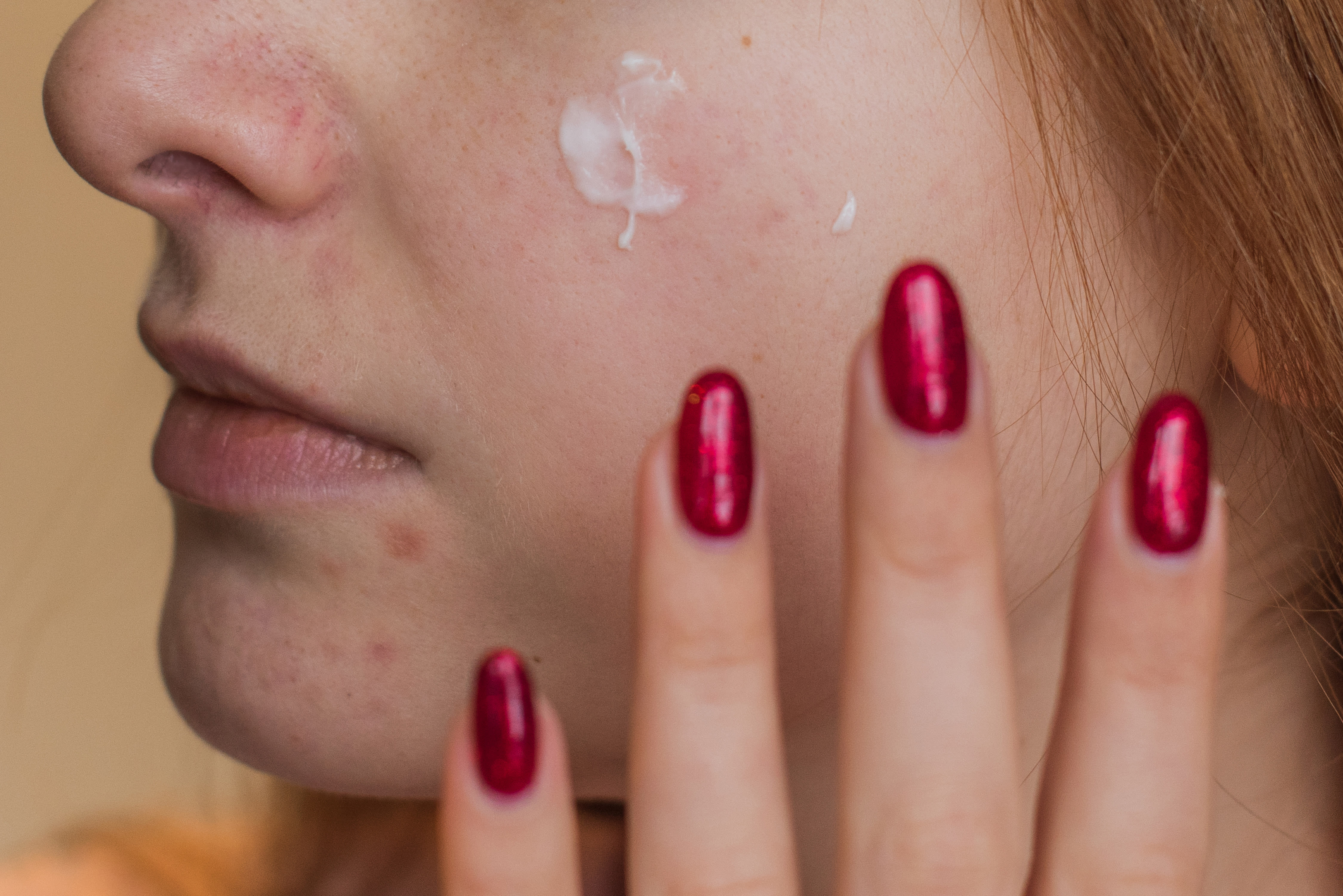 Natural Hormonal Acne Treatment for PCOS
