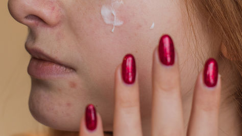 Natural Hormonal Acne Treatment for PCOS