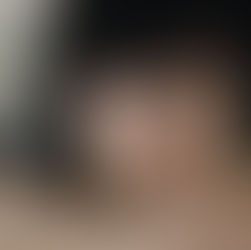 What Is Keratoconus? A Guide for Parents