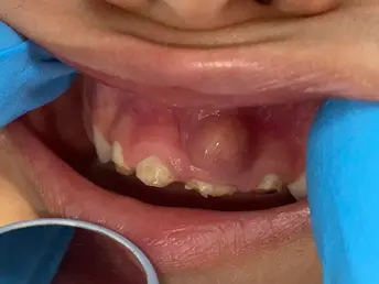 Abcesul Dentar Gingival la Copii