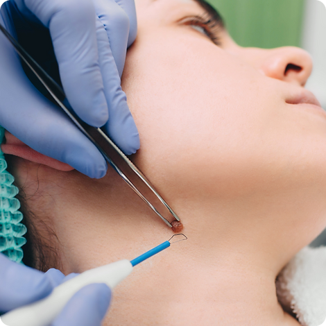 warts removal in Dubai