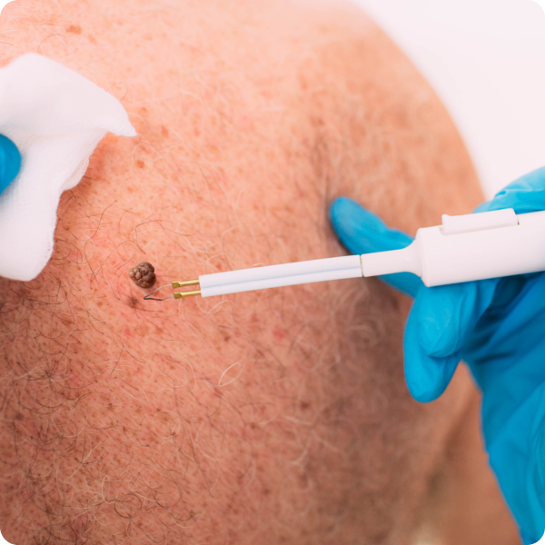 Best Warts Treatment in Dubai: Symptoms, Treatment, and Homeopathic Solutions