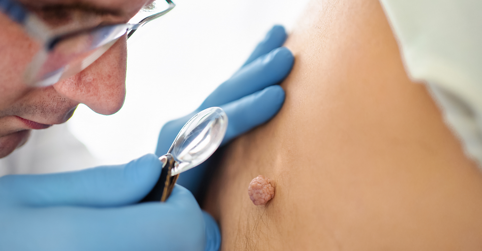 warts treatment in Dubai