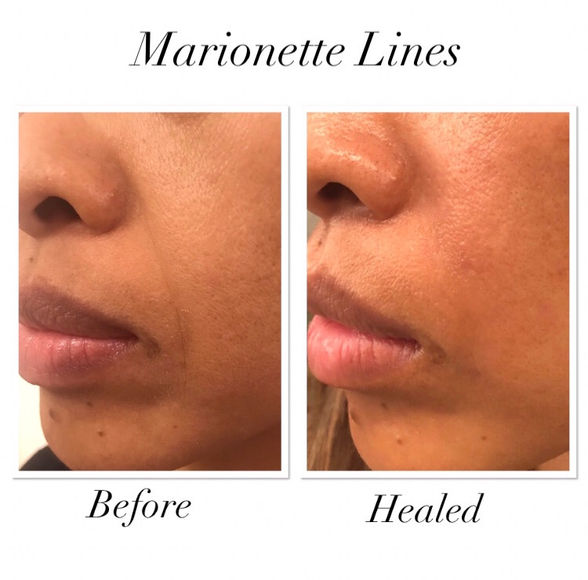 Plasma Fibroblast Before and After: Smile lines 4 weeks healed