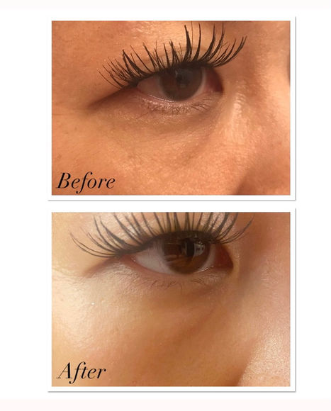 Before & After Plasma Fibroblast full eye rejuvenation