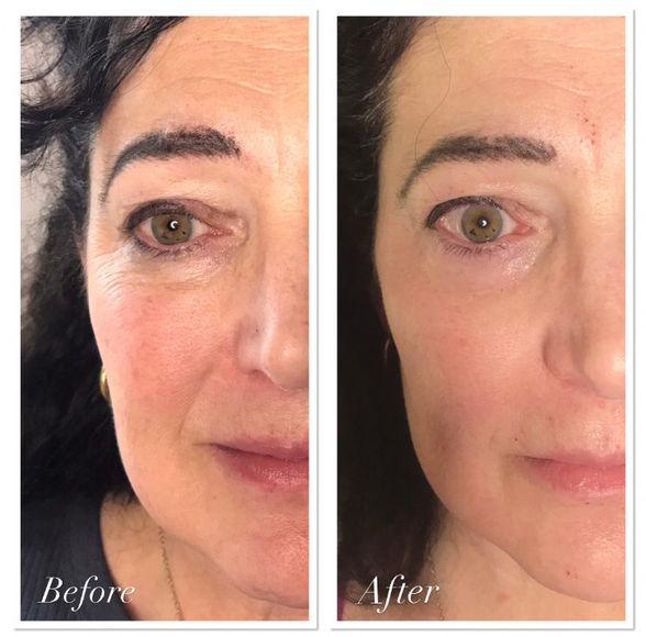 Plasma Fibroblast Before and After: Full Face Rejuvenation, One Week Healed