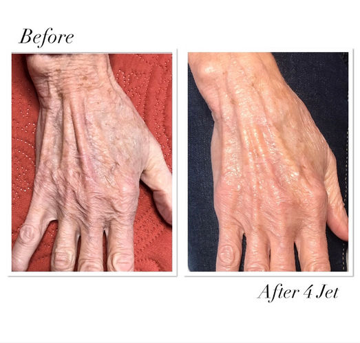 Before & After Jet Hand Treatment
