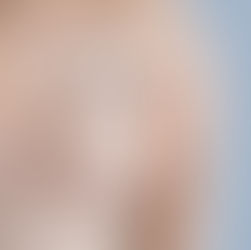 Quando devo fazer a mamoplastia redutora?