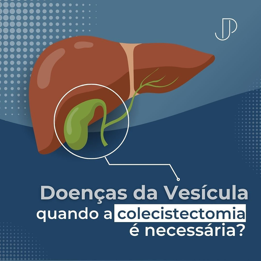 Doenças da vesícula: quando a colecistectomia é necessária?