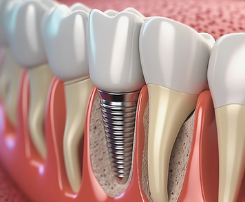 Dental Implant.png