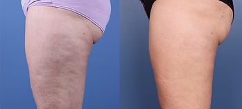 SO_M8_1b_cellulite_edited.jpg