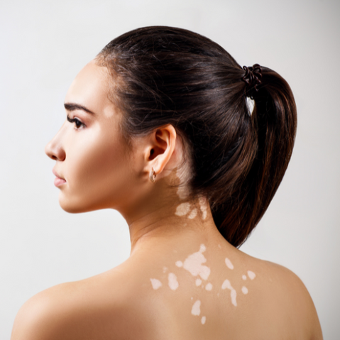 Effective Vitiligo Treatment at The Skin Doctors 