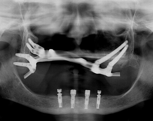 Cancro oral: maxilectomia parcial após carcinoma oral com comunicação oro-antral