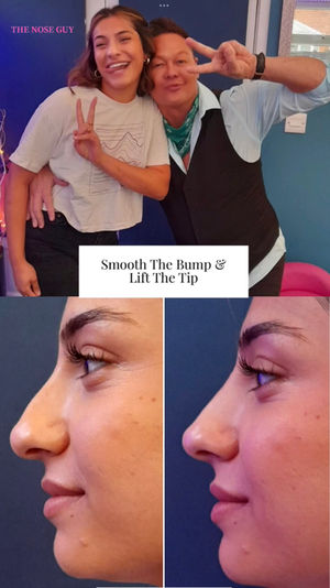 Nose job reshaping in Northampton for Hadia, rhinoplasty non surgical with fillers.