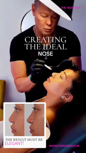 real clients with real results, by Greg Andrew the number 1 nasal Specialist in non surgical rhinoplasty in London Northampton Birmingham