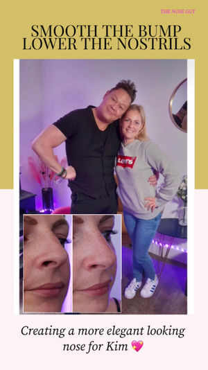 With the nose guy you can get your nose job with fillers in Northampton that’s non surgical rhinoplasty