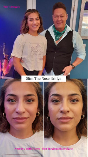  A nose job to slim the bridge is a very often requested non surgical procedure in Northampton with fillers