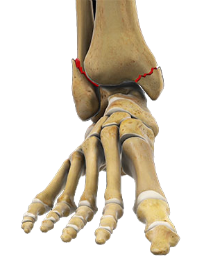 Fratura de tornozelo