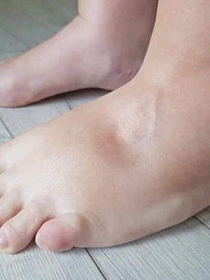 Notou um "caroço" no pé? Pode ser um lipoma!