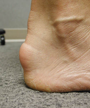 Tendinite insercional do Aquiles