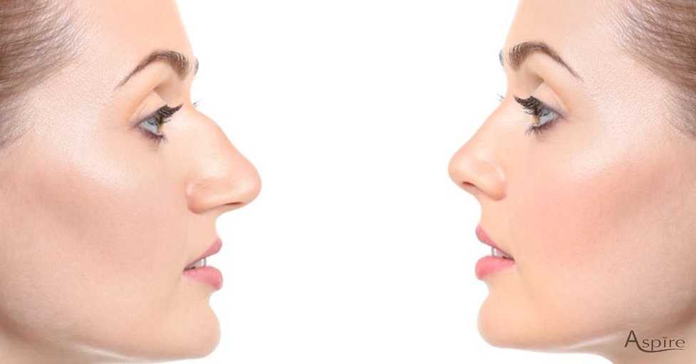 Non-Surgical Rhinoplasty Before and After
