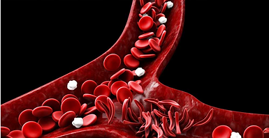 sickled cells in a vein