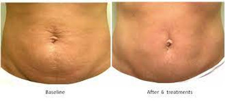 Skin Tightening