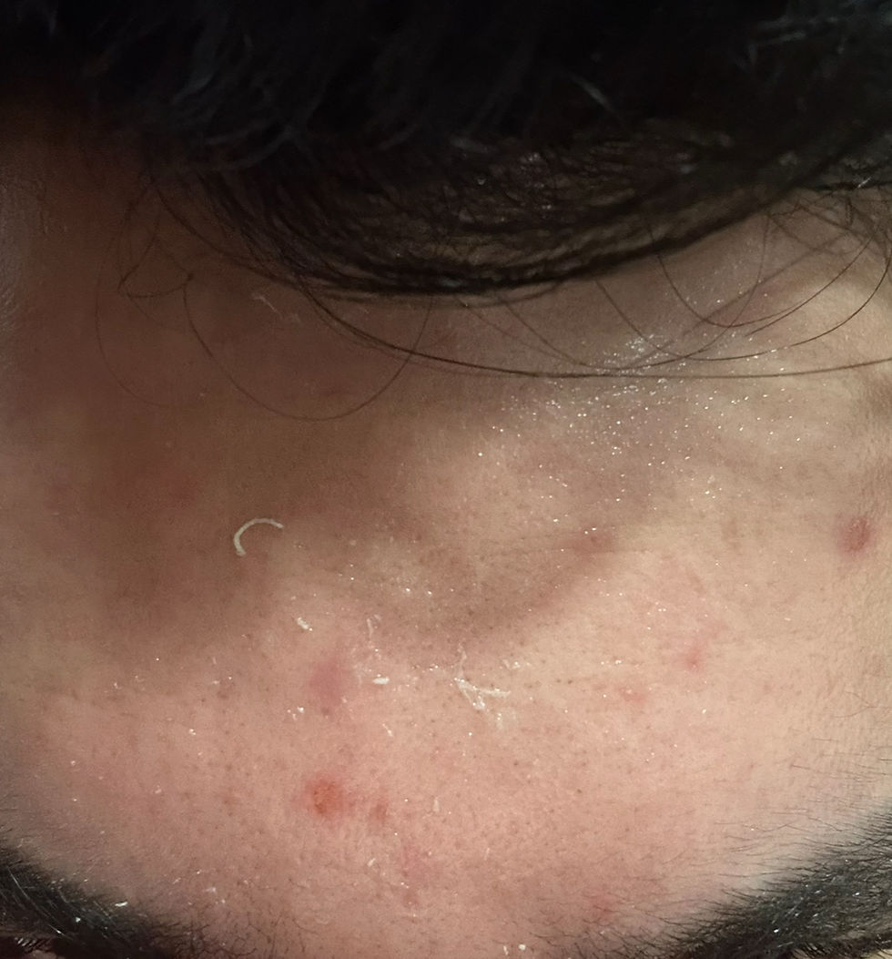 Dia 1 Usando Acne Defense 5D Creamy