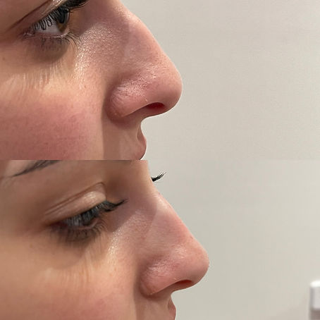 nonsurgicalrhinoplast-brisbane.jpeg