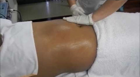 Why is Lymphatic Drainage so important after a Lyposuction.