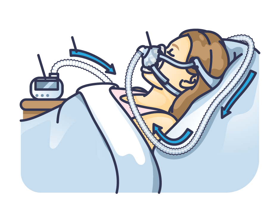 Woman sleeping with a CPAP mask, connected to a machine. Illustration depicts airflow with arrows. Calm setting with blue tones.