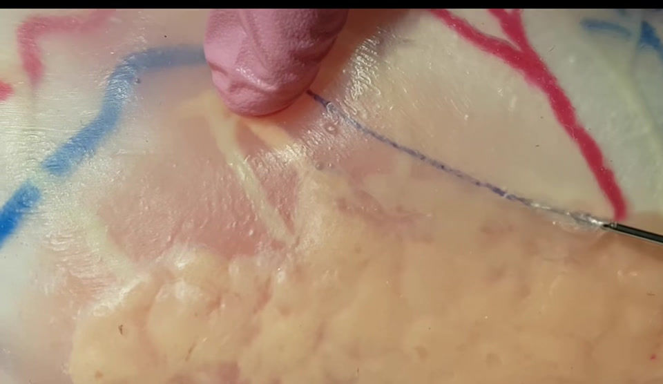 Thumbnail: Facial Injection Simulator