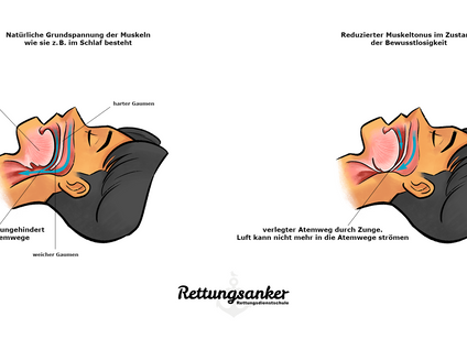 Vergleichsgrafik: Atemwege bei normalem Muskeltonus (z. B. im Schlaf) vs. verlegte Atemwege durch zurückgesunkene Zunge bei Bewusstlosigkeit.