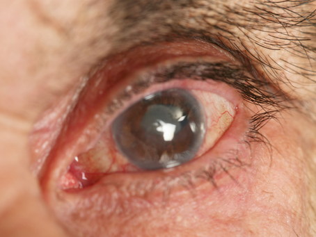 Advancements in Cataract Surgery