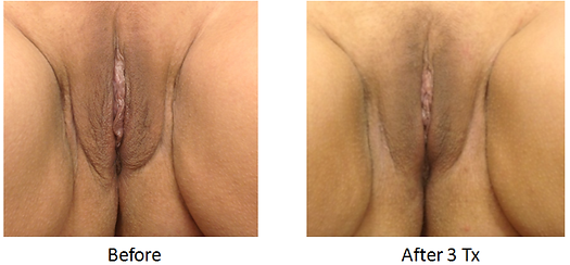 RJ CLINIC Labial rejuvenation Treatment