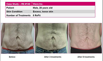 RJ CLINIC Viora RF Skin Tightening Treatment