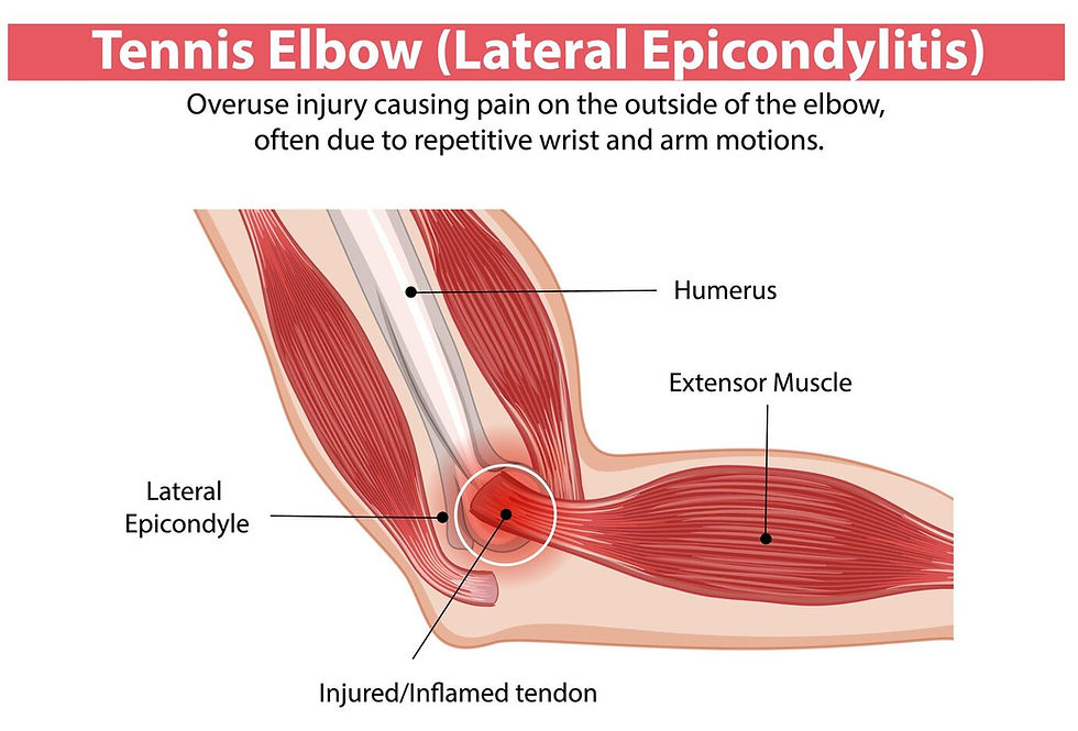 An illustration of Tennis Elbow