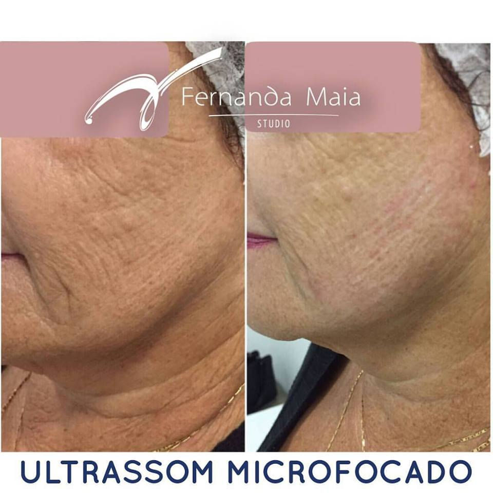 Ultrassom Microfocado Vithara