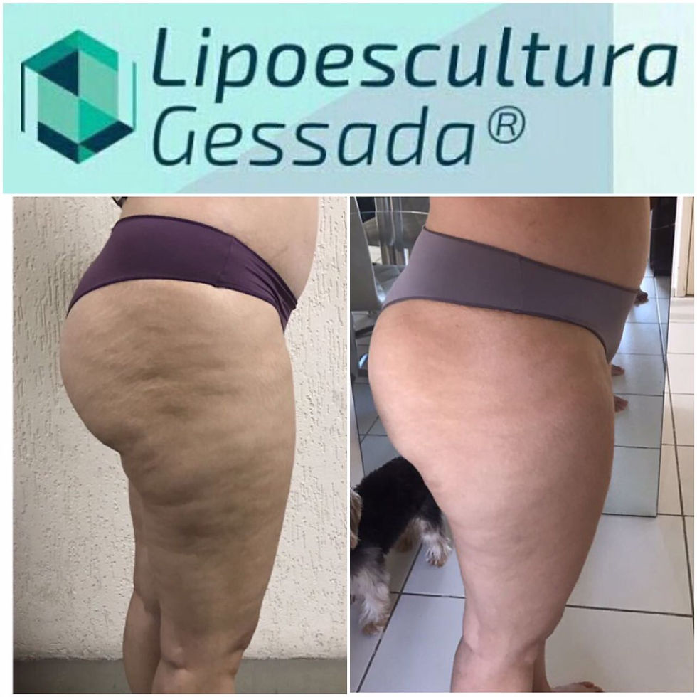 Lipoescultura Gessada