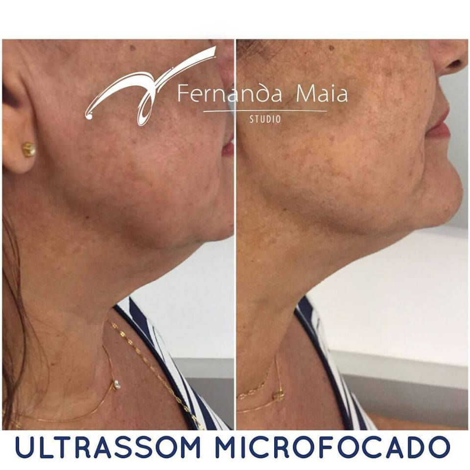 Ultrassom Microfocado Vithara